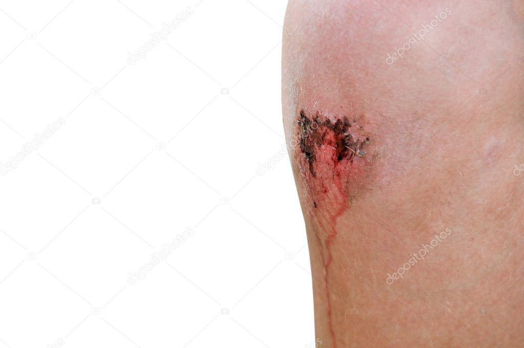 Scraped Knee