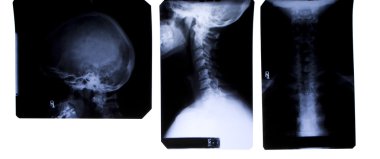 Neck X-Ray - front and side clipart