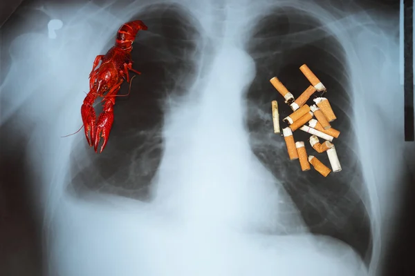 폐암 — 스톡 사진