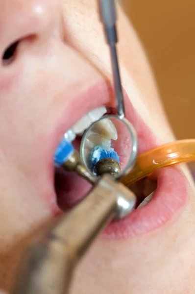 Blanqueamiento de dientes —  Fotos de Stock