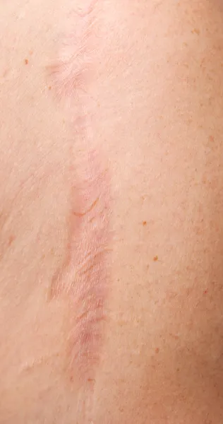 Cicatriz da pele — Fotografia de Stock