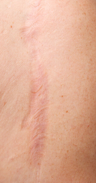 Skin scar