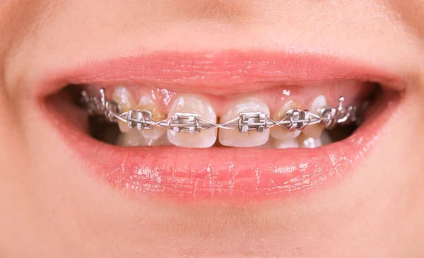 Aparate dentare — Fotografie, imagine de stoc