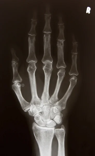 stock image X-ray picture of hand