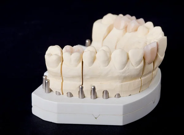 Modelo de cera dental — Foto de Stock