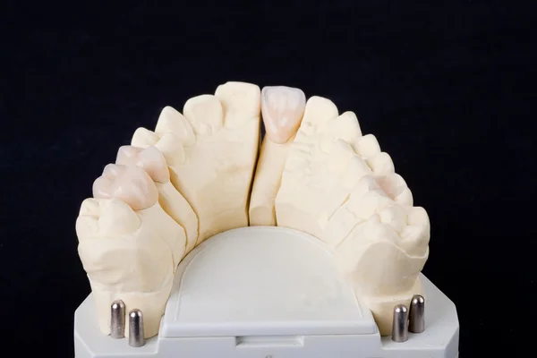 Tandheelkundige wax model — Stockfoto