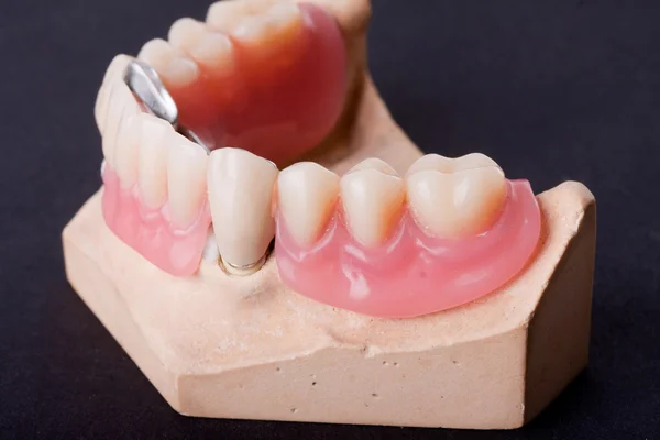 Modelo de cera dental —  Fotos de Stock