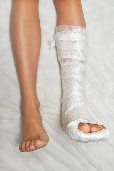 Złamana noga — Zdjęcie stockowe