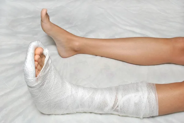 Złamana noga — Zdjęcie stockowe