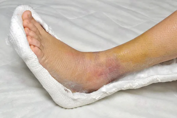Сломанная нога — стоковое фото