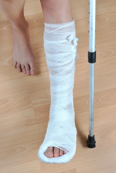 骨折した足 — ストック写真