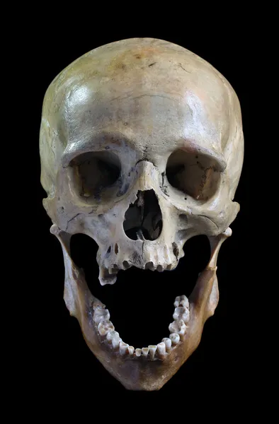 El cráneo de la persona . —  Fotos de Stock