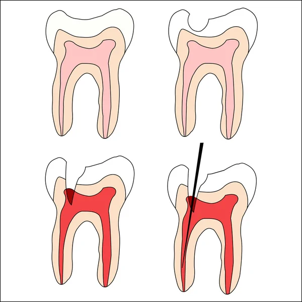 Jeu Dents Vecteurs Traitement Dentaire — Image vectorielle