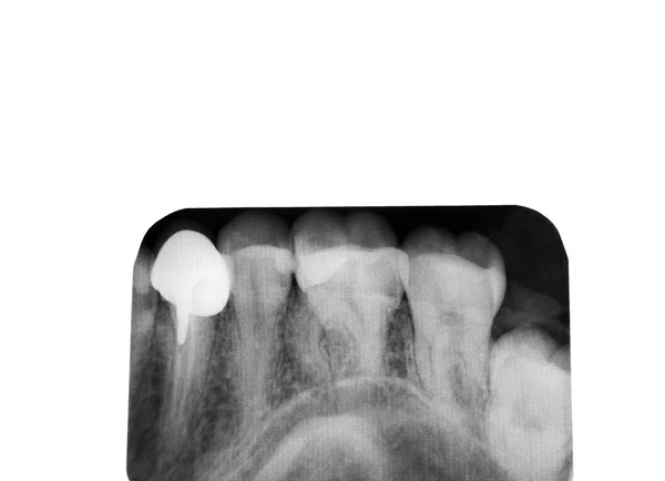 Οδοντιατρική ακτινογραφία — Φωτογραφία Αρχείου
