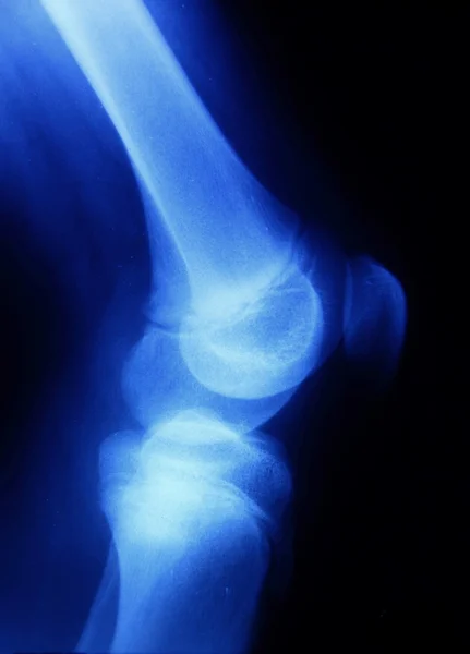 Huesos de rodilla —  Fotos de Stock
