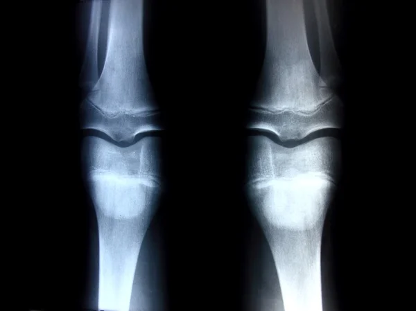 Ossa del ginocchio — Foto Stock