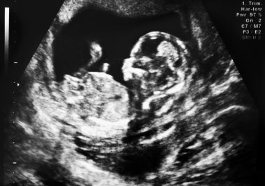 Ultrasound of fetus clipart