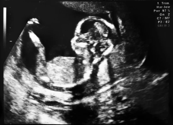 stock image Ultrasound of fetus