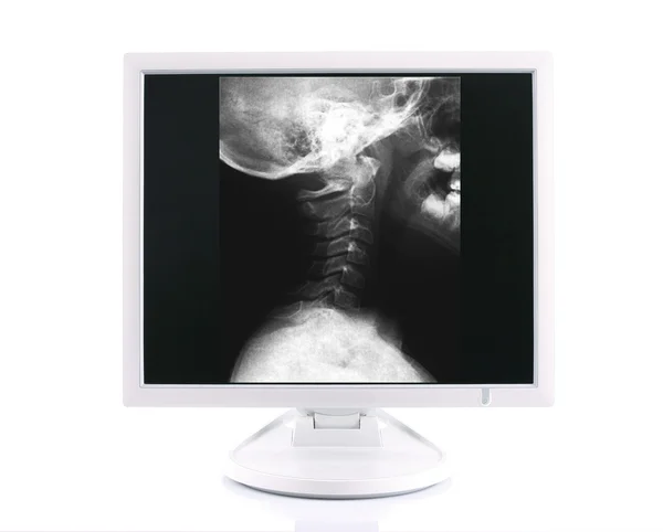 X-ray image and compute — Stock Photo, Image