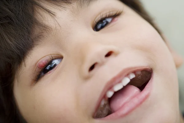Niño pequeño con una pocilga en el ojo sonriendo a la cámara — Foto de Stock