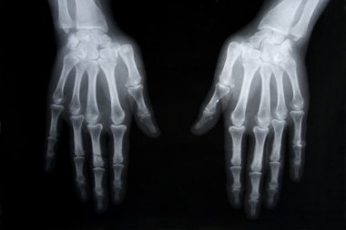 X-ray picture of human hands clipart