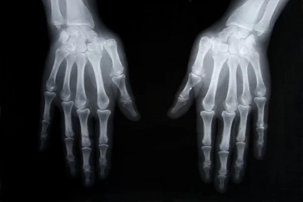 stock image X-ray picture of human hands