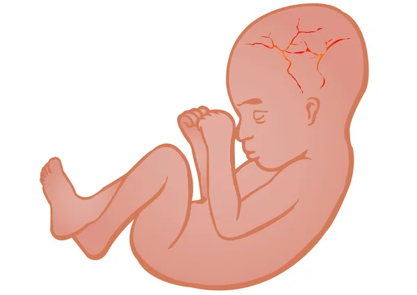 Vector illustratie kiem in een baarmoeder van de moeder — Stockvector