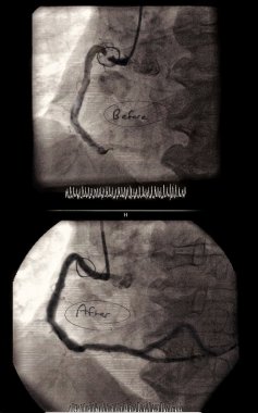 gerçek anjiyoplasti görüntüleri önce ve sonra