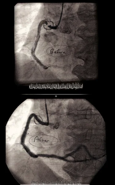 Gerçek anjiyoplasti görüntüleri önce ve sonra — Stok fotoğraf