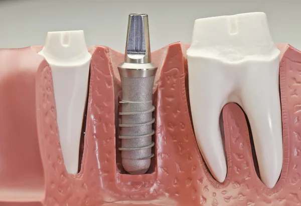 Zubní implantát modelu — Stock fotografie
