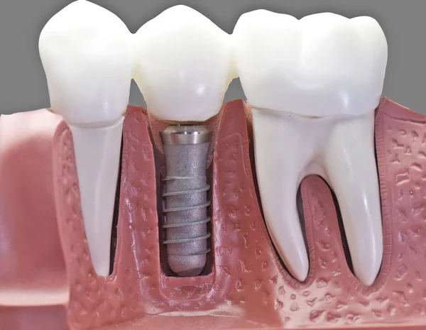 Dental Crowns