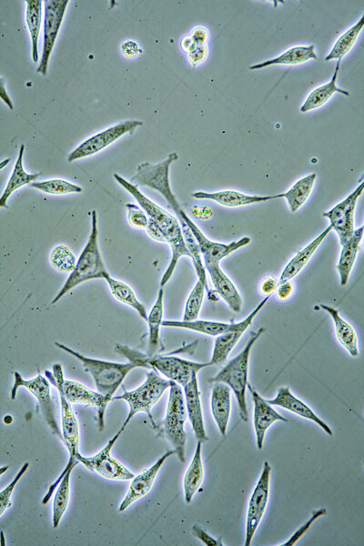 Раковые клетки простаты
