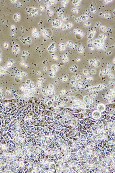 Раковые клетки толстой кишки — стоковое фото