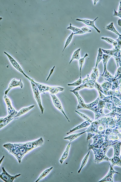 Vue Microscope Santé Masculine Prostate Cellules Cancéreuses Culture Tissulaire Montrant — Photo