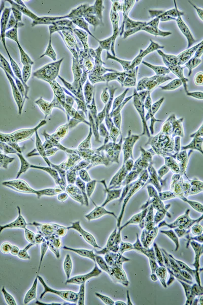 Cellule tumorali della prostata — Foto Stock