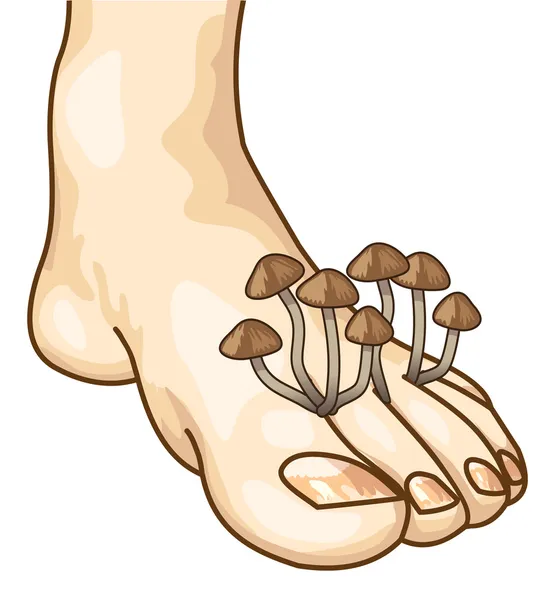 stock vector Mycosis between the toes. Vector illustration.