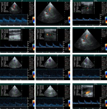 Echo cardiogram clipart