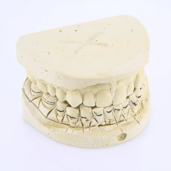Mold of teeth — Stock Photo, Image