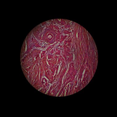 Scirrhus of mammary gland clipart