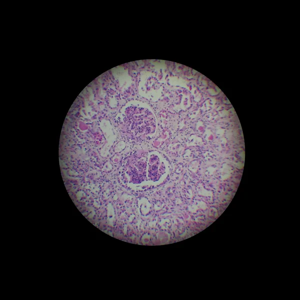 stock image Extracapillary glomerulonephritis