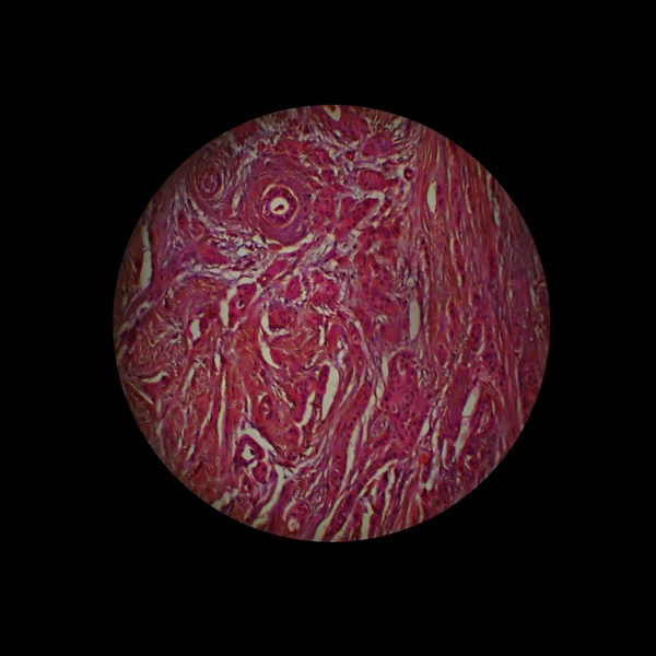 Scirrhus gruczołu piersiowego — Zdjęcie stockowe