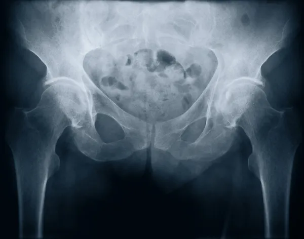 stock image X-ray with bolt