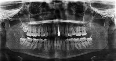 Implanted tooth on a steel pin. X-ray of female jaw. Scanned from the film clipart