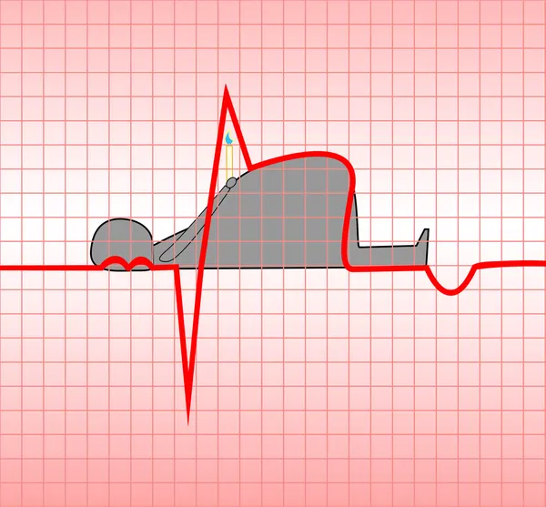 Enfarte do miocárdio — Vetor de Stock