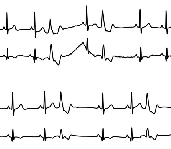 Diagramme zu Herzerkrankungen — Stockvektor
