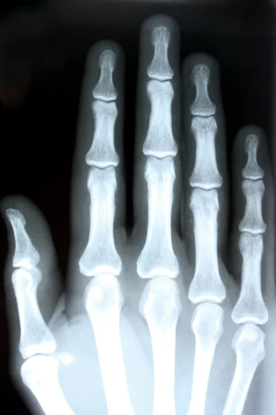 stock image Radiograph of a hand