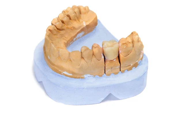 歯科金型 ロイヤリティフリーのストック写真