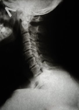 Detail of neck and part of head x-ray clipart