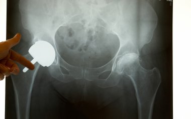 X-ray of a Hip Prosthesis clipart