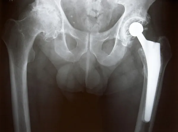 Rayon X de remplacement de la hanche — Photo